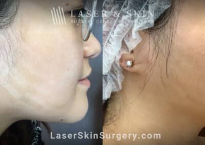 LaseMD treatments to address IPL-induced hypopigmentation