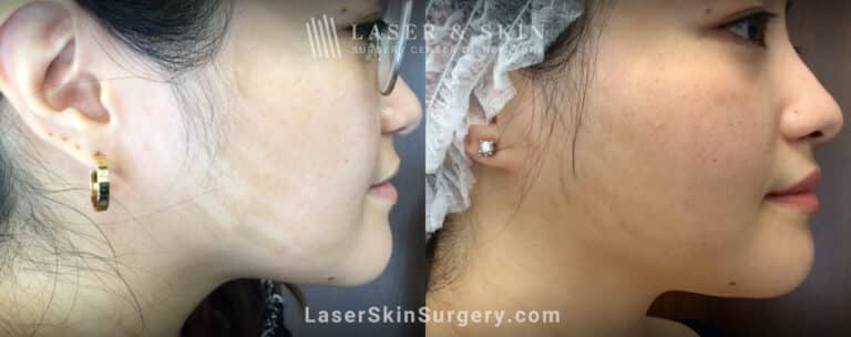 LaseMD treatments to address IPL-induced hypopigmentation