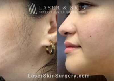 LaseMD treatments to address IPL-induced hypopigmentation