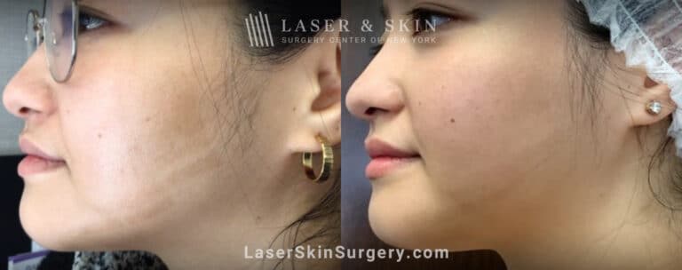 LaseMD treatments to address IPL-induced hypopigmentation