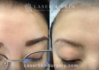 LaseMD treatments to address IPL-induced hypopigmentation