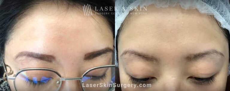 LaseMD treatments to address IPL-induced hypopigmentation