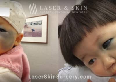 Q-switched Ruby laser to reduce the appearance of port wine birthmark on infant’s face