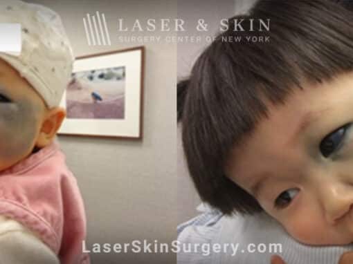 Q-switched Ruby laser to reduce the appearance of port wine birthmark on infant’s face