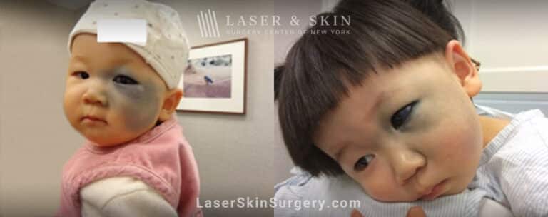 Q-switched Ruby laser to reduce the appearance of port wine birthmark on infant’s face