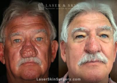 Radiofrequency ablation and erbium laser to reduce the symptoms of rhinophyma