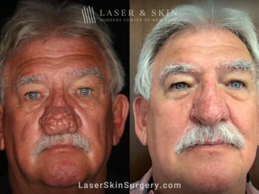 Radiofrequency ablation and erbium laser to reduce the symptoms of rhinophyma