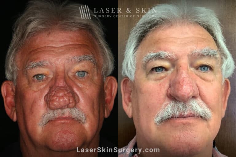 Radiofrequency ablation and erbium laser to reduce the symptoms of rhinophyma