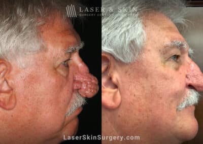 Radiofrequency ablation and erbium laser to reduce the symptoms of rhinophyma
