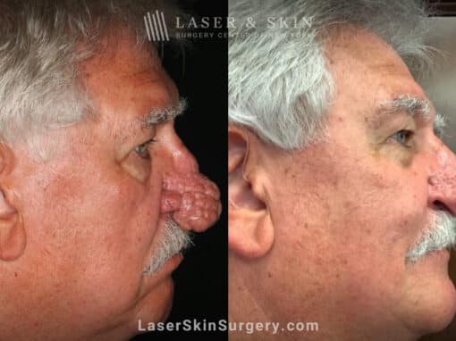 Radiofrequency ablation and erbium laser to reduce the symptoms of rhinophyma