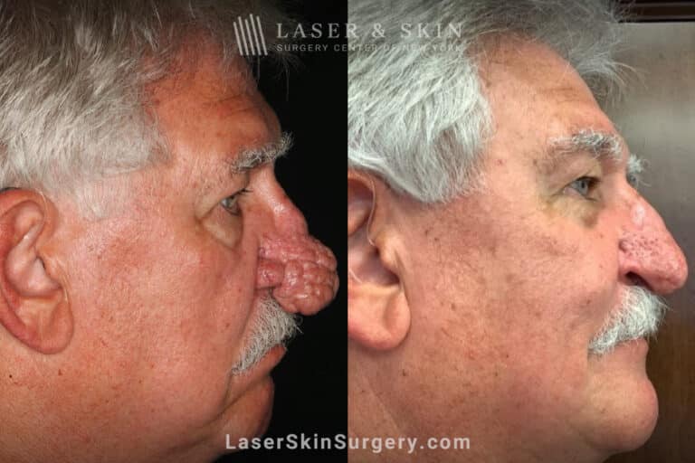 Radiofrequency ablation and erbium laser to reduce the symptoms of rhinophyma