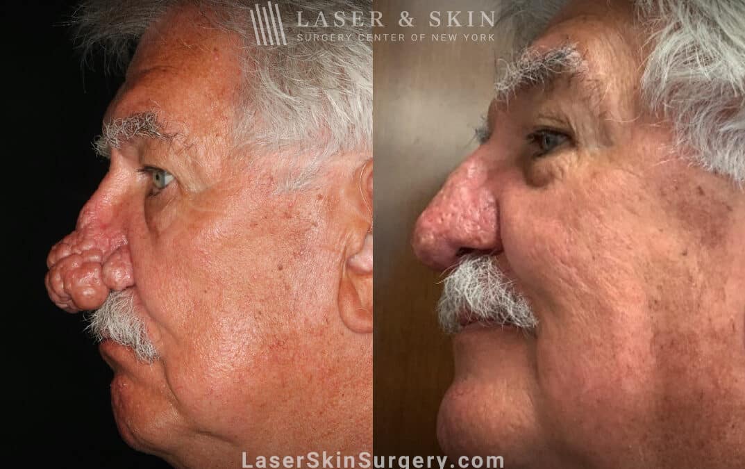 Radiofrequency ablation and erbium laser to reduce the symptoms of rhinophyma