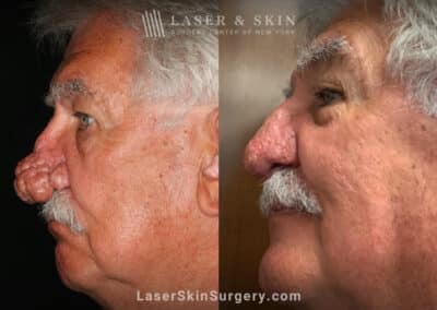 Radiofrequency ablation and erbium laser to reduce the symptoms of rhinophyma
