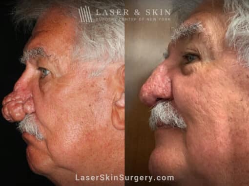 Radiofrequency ablation and erbium laser to reduce the symptoms of rhinophyma