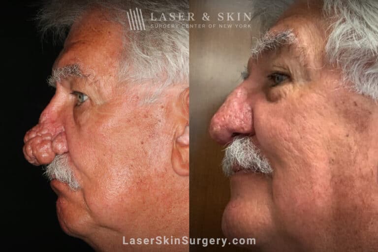 Radiofrequency ablation and erbium laser to reduce the symptoms of rhinophyma