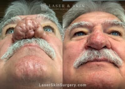 Radiofrequency ablation and erbium laser to reduce the symptoms of rhinophyma
