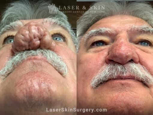 Radiofrequency ablation and erbium laser to reduce the symptoms of rhinophyma