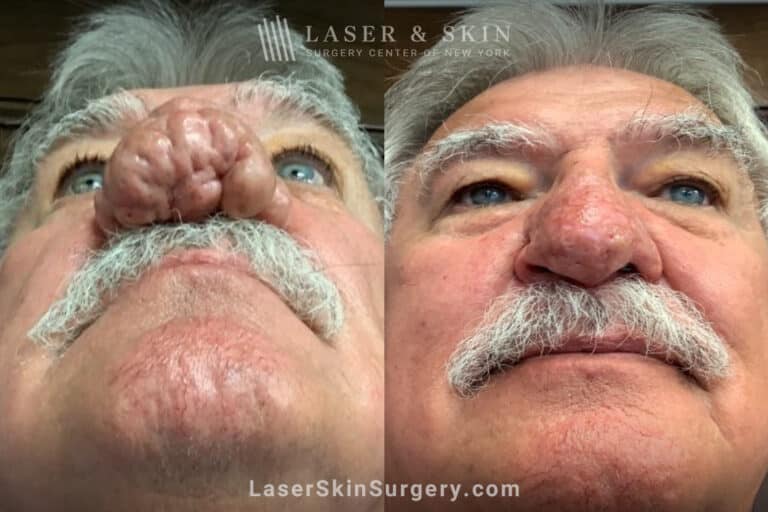 Radiofrequency ablation and erbium laser to reduce the symptoms of rhinophyma