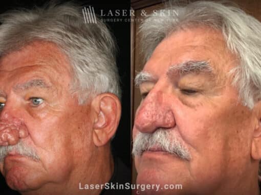 Radiofrequency ablation and erbium laser to reduce the symptoms of rhinophyma