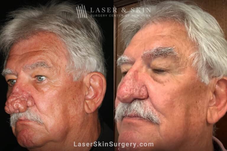 Radiofrequency ablation and erbium laser to reduce the symptoms of rhinophyma