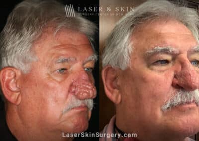 Radiofrequency ablation and erbium laser to reduce the symptoms of rhinophyma