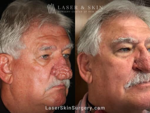 Radiofrequency ablation and erbium laser to reduce the symptoms of rhinophyma