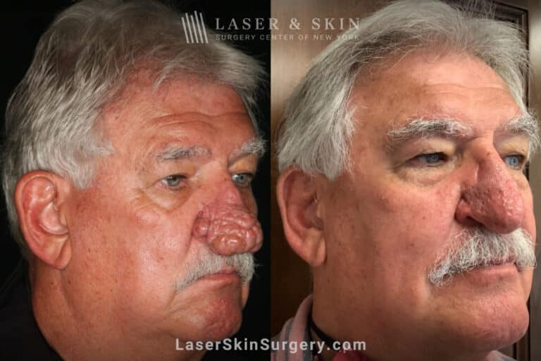 Radiofrequency ablation and erbium laser to reduce the symptoms of rhinophyma