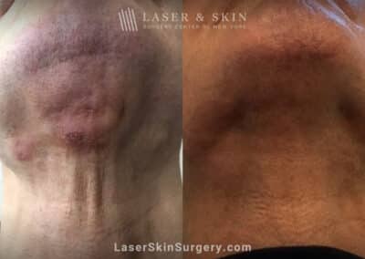 Vbeam and Genius treatments to reduce scarring underneath the chin