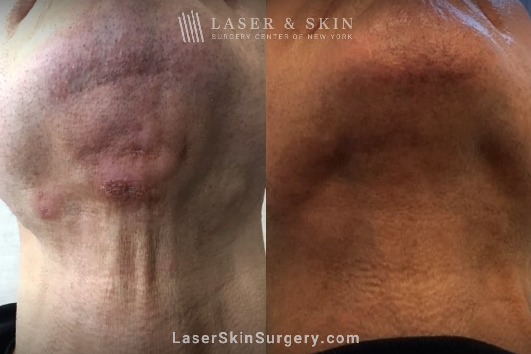 laser scar treatment results after the vBeam procedure