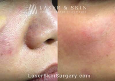 Erbium laser treatments to reduce xanthoma above the cheek