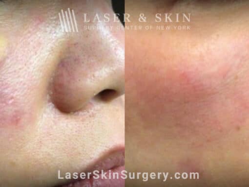 Erbium laser treatments to reduce xanthoma above the cheek