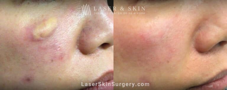 Erbium laser treatments to reduce xanthoma above the cheek