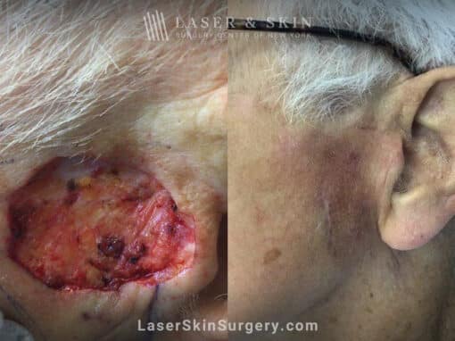 Mohs surgery to remove skin cancer from the cheek