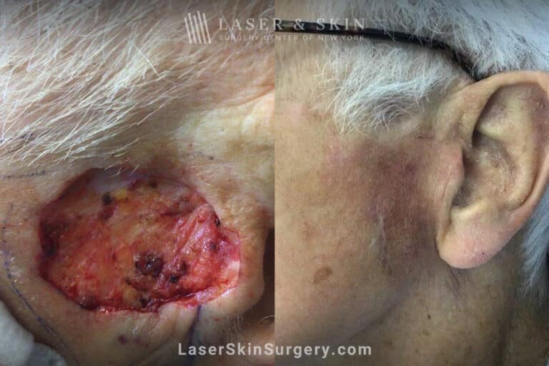 Mohs surgery to remove skin cancer from the cheek