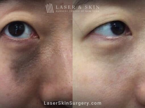 Picoplus laser treatments to remove nevus of ota from underneath the eye