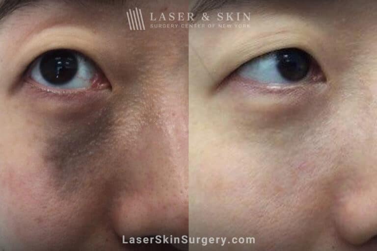 Picoplus laser treatments to remove nevus of ota from underneath the eye