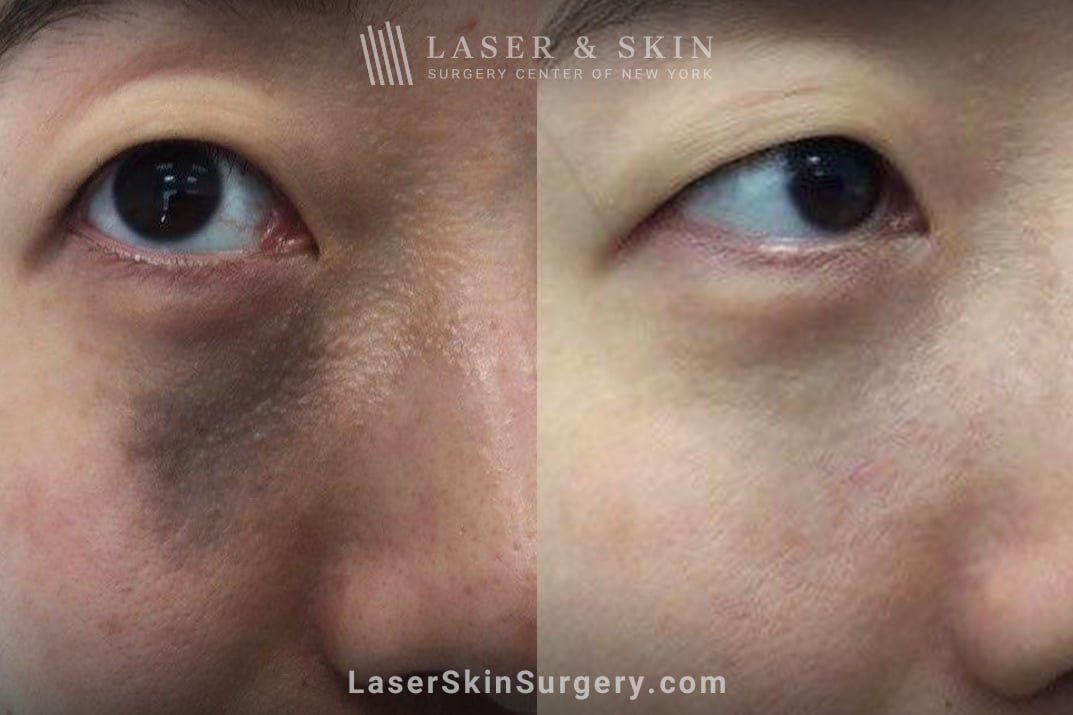 LSSCNY-Shelton-Nevus-Of-Ota-Birthmark-Five-Picoplus-Laser-Treatments fraxel laser for facial wrinkles before and after