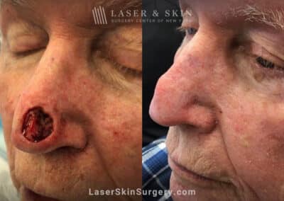 Mohs surgery to remove skin cancer from the nose