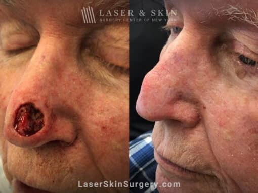 Mohs surgery to remove skin cancer from the nose