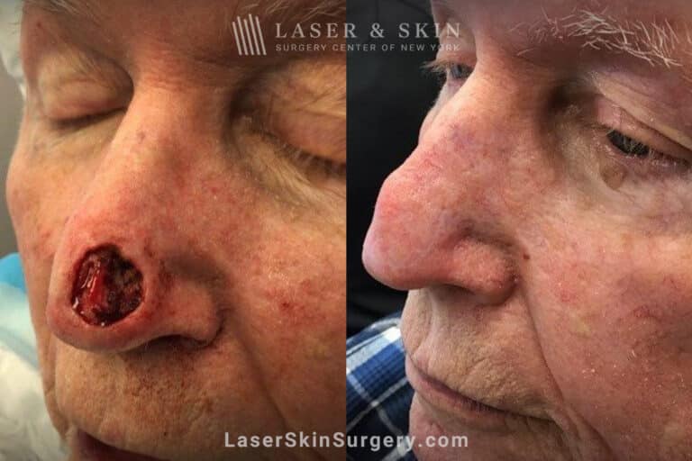 Mohs surgery to remove skin cancer from the nose