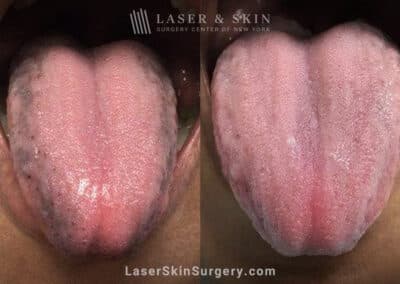 Ruby laser to minimize pigmented papilla on the tongue