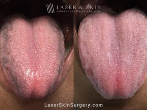 Ruby laser to minimize pigmented papilla on the tongue