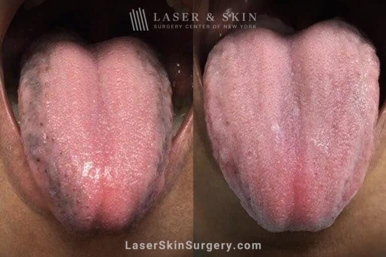 Ruby laser to minimize pigmented papilla on the tongue