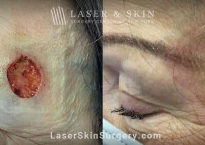 Mohs surgery to remove skin cancer from the temple