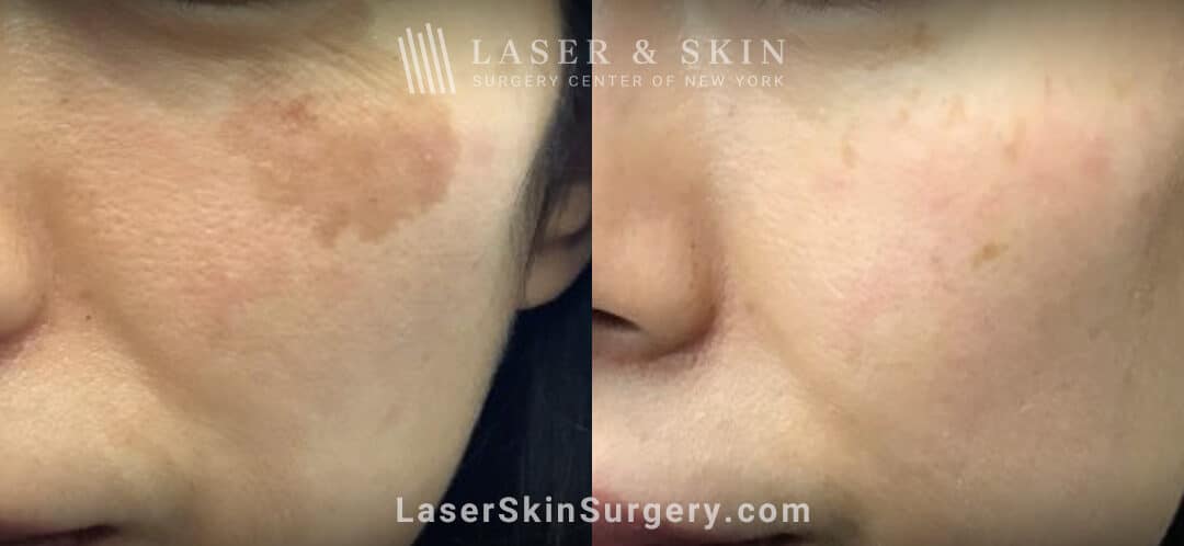 LaseMD treatments to minimize IPL-induced hypopigmentation on the cheek