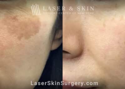 LaseMD treatments to minimize IPL-induced hypopigmentation on the cheek