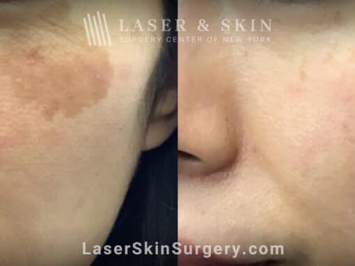 LaseMD treatments to minimize IPL-induced hypopigmentation on the cheek