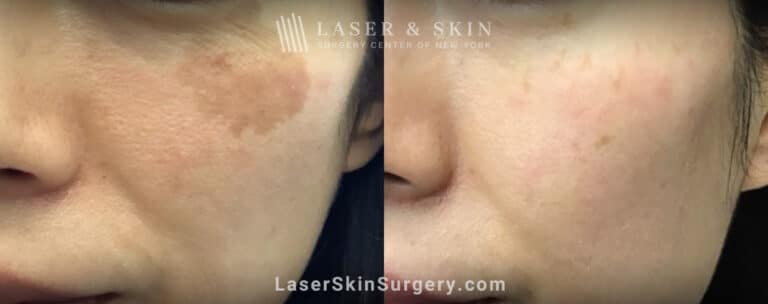 LaseMD treatments to minimize IPL-induced hypopigmentation on the cheek