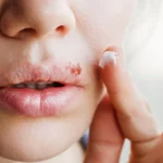 Cold Sores Explained: Causes, Symptoms, And Treatments