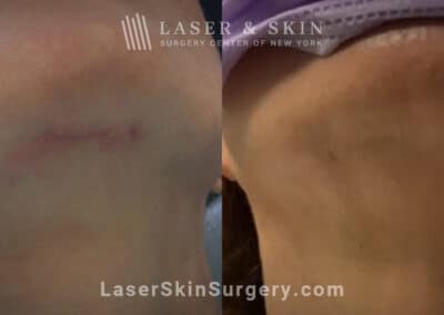 Picoplus treatments to reduce facelift scarring